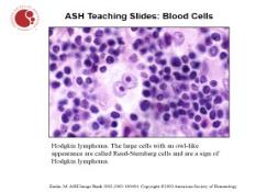 Hodgkin lymphoma PowerPoint Presentation