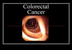 Colon Cancer PowerPoint Presentation