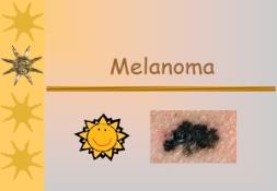 Overview of Melanoma PowerPoint Presentation