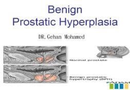 (BPH) Benign Prostatic Hyperplasia PowerPoint Presentation