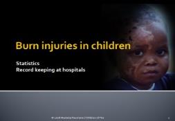 Burn injuries in children PowerPoint Presentation