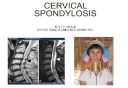 CERVICAL SPONDYLOSIS PowerPoint Presentation