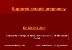 Ruptured Ectopic Pregnancy PowerPoint Presentation