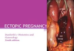 AN INTRO ECTOPIC PREGNANCY PowerPoint Presentation