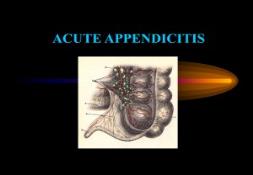 LEARN ABOUT ACUTE APPENDICITIS PowerPoint Presentation