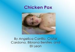 Overview Chicken Pox PowerPoint Presentation