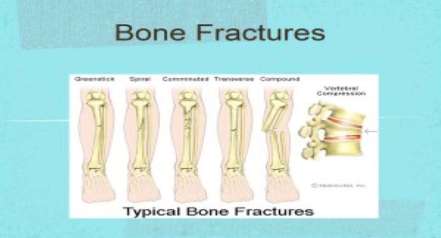 Free Download Bone Fractures-Wikispaces PowerPoint Presentation Slides