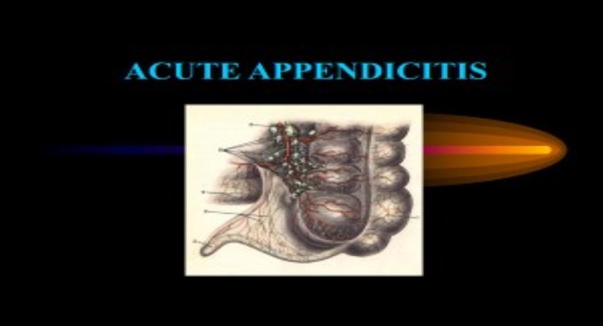 Free Download Learn About Acute Appendicitis Powerpoint Presentation