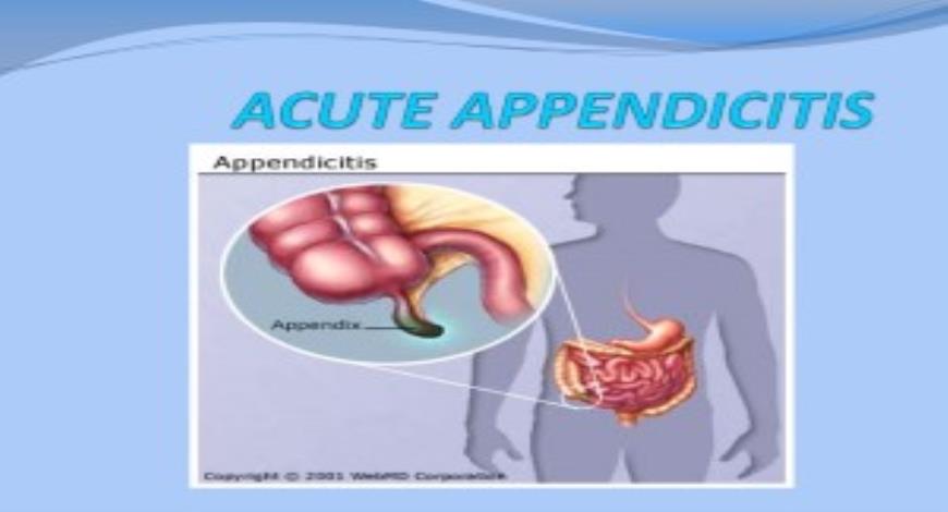 Free Download About Acute Appendicitis Powerpoint Presentation 3912