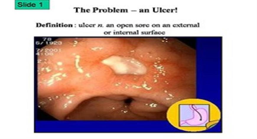 Free Download Bacteria Helicobacter Pylori Ulcers PowerPoint